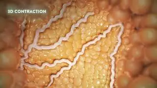 BreastTite &ndash; Non-Surgical Breast Lift & Contouring #EliteBio #RaleighAesthetics