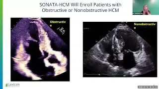 HCMA Special Edition Webinar   SONATA HCM offered by Lexicon, Clinical Trial Opportunities
