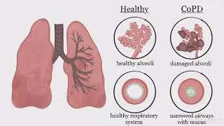 Causes of COPD#anmnursing #COPDsign #COPD