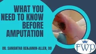 What You Need to Know Before Your Amputation