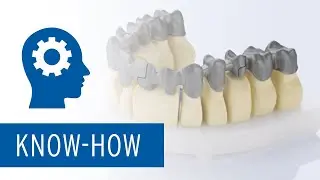 Ceramill Sintron - Gro&szlig;spannige Arbeiten mit Bridge Split