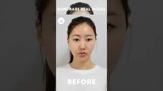 BANOBAGI MEDICAL GROUP - Before & After💓 Full Face Contouring+Undereye Fat Repositioning 💓