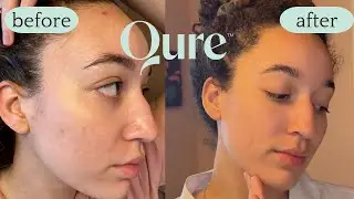 Qure MicroInfusion Treatment ✨ for Acne Scars, Hyperpigmentation, Fine Lines & Dull Skin
