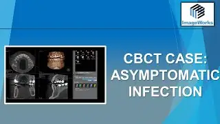 CBCT Case:  Asymptomatic infection