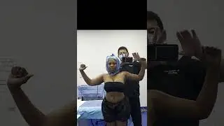 Celebrity Arms&trade; Before & After | Dr. Su&rsquo;s 360&deg; Awake Liposuction Transformation | Immediate Results!