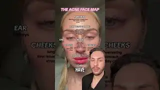 Картирование кожи лица с акне | Что означают ваши прыщи? | MaximumSkin