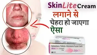 Skinlite cream side effects | skin light cream - लगाने से पहले यह वीडियो जरूर देखें |