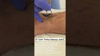 Laser Tattoo Removal in Dubai | Safe & Effective Treatment at EDEN Aesthetics Clinic