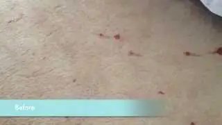 Blood Stain Removal