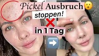 Meine 🆘-Methode: Pickel in 1 Tag loswerden