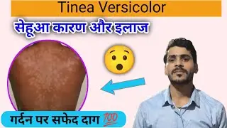 सेहुआ,सफेद चकतो की बीमारी - कारण और इलाज ।Tinea versicolor, pityriasis versicolor Treatment