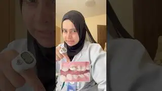 Как удалить черные пятна с зубов. #черныезубы #отбеливаниезубов #желтыезубы #безфторида