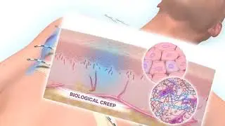 ABRA Adhesive Skin Anchor: Non-Invasive Solutions for Faster Recovery