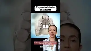 Expansi&oacute;n Maxilar quir&uacute;rgica en adultos