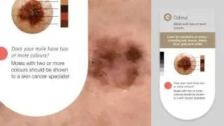 MoleMap Skin Check Tool Tutorial