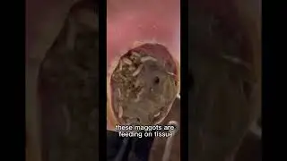 FOOT INVADED WITH MAGGOTS