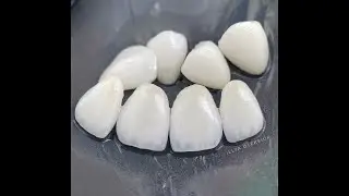 Feldspathic Veneers on refractory виниры зубной техник dental technician