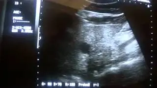 liver cyst simple in Lt lobe of liver