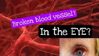 Why does BROKEN BLOOD VESSEL in the EYE happen? Prevention and treatment #hypertension
