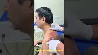 Functional cupping done by dr Nisha yadav PT