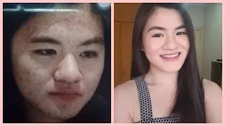 How I Got Rid of My Acne | Sonella Go
