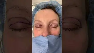 Upper Blepharoplasty - Before and Immediately After!