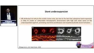 K. Kalogeras | Key focused slides: How to treat stent failure