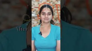 Hari Priya | Face Lifting | Maynee Cosmetology Clinic