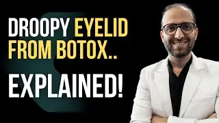 Botox Gone Wrong | Explained