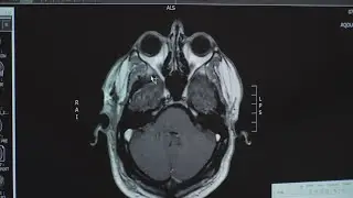Medical Minute: COVID Impact On Brain, Sense Of Smell