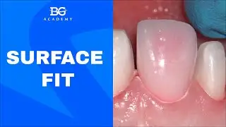Surface fit