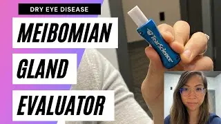 Dry Eye Disease: Korb Meibomian Gland Evaluator (MGE)