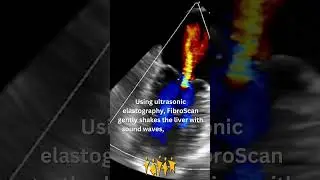 Meet the FibroScan