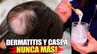 &iexcl;Elimina la DERMATITIS, CASPA y SEBORREA! Receta R&aacute;pida y Casera.