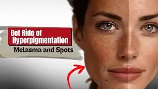 Pigmentation Treatment at Home| How to Actually Fade Hyperpigmentation Tips & Products