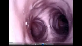 Bronchoscopy Simulator Plan 3D