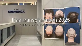 Haartransplantation 2025 - Kapitel 2: Der 1. Monat nach der OP