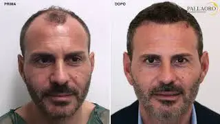 ll trapianto capelli Micro FUE di Michele