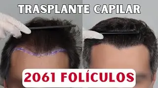 😱 Trasplante de Pelo SIN RAPAR | Resultado natural con 2061 Folículos en ESPAÑA 🌟