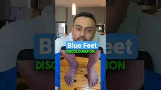Foot Doctor Explains Blue Feet 😱#health #medical #viral