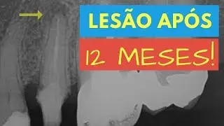 QUAL A CONDUTA EM CASO DE LES&Atilde;O EM UM DENTE TRATADO H&Aacute; 1 ANO? - QUICK TIP ENDOLOVERS