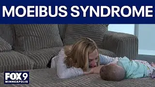 9-month-old baby with rare condition can&rsquo;t blink or smile