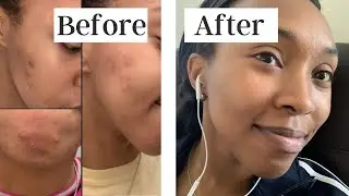 How I finally CLEARED MY SKIN, post Curology | MASKNE, Hormonal acne, and DARK SPOTS