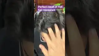 Perfect Result of FUE Hair Transplant || Dr. Habib Ullah Shah #drhabibhairtransplant #best #shorts