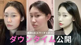 輪郭2点(エラ＋オトガイ)で垢抜けすぎて友達に気づかれちゃいました🤣 #輪郭整形