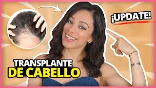 TRASPLANTE CAPILAR / ACTUALIZACION DE DOS AÑOS