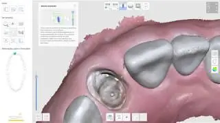 Implantes Denários com o Uso de Scanbody - Scanner Intraoral Medit i500