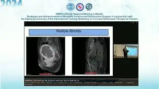 Infertility with uterine fibroids and adenomysis – How can HIFU help
