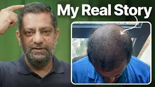 I Was Days Away From a Hair Transplant... Then This Happened! | Traya Review