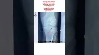 #Diaqnoz: #qamış s&uuml;m&uuml;y&uuml; bayır plato &ccedil;&ouml;kmə sınığı #Əməliyyat: #metal l&ouml;vhə ilə #osteosintez. #graft